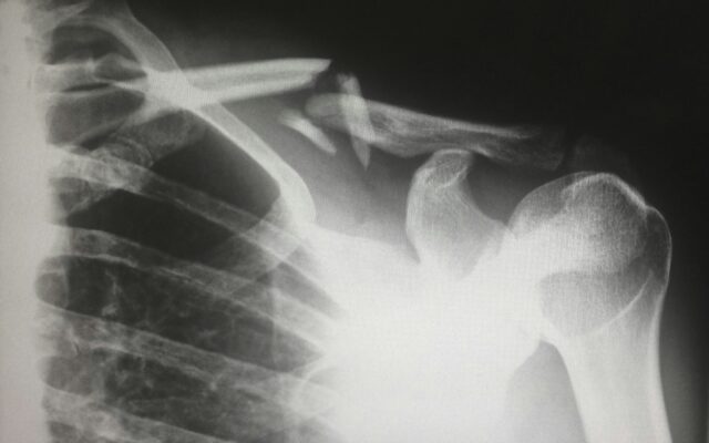 x-ray of broken shoulder