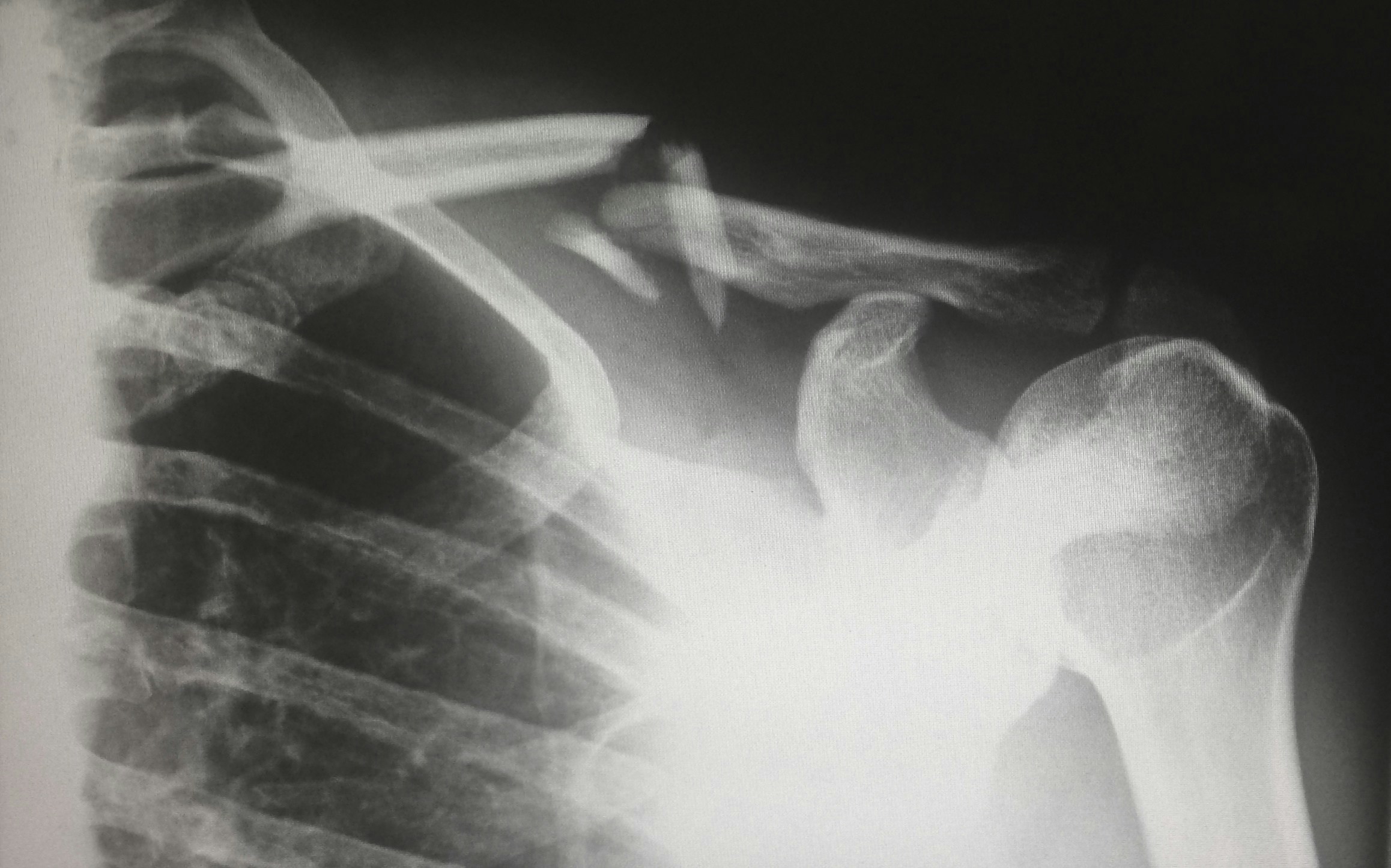 x-ray of broken shoulder